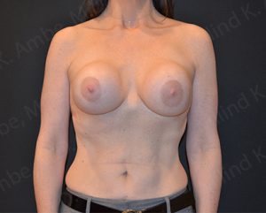 Breast Lift Patient