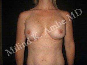 Breast Implant Revision Patient