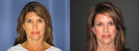 In Sunny Orange County, Newport Beach Plastic Surgery Produces Facelift to Reverse Sun and Environmental Damage