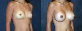 Orange County Breast Augmentation Specialist Ensures Patient Comfort in Implant Sizing Decisions