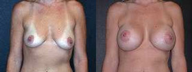 Orange County Breast Augmentation Specialist Ensures Patient Comfort in Implant Sizing