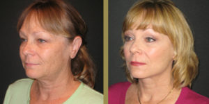 Newport Beach Plastic Surgeon Dr. Milind Ambe, Performs Face Lift on Season 4 of The Real Housewives of Orange County.