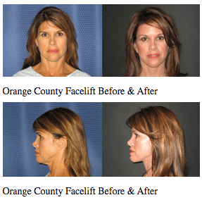 In Sunny Orange County, Newport Beach Plastic Surgery Produces Facelift To Reverse Sun And Environmental Damage