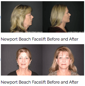 Newport Beach Plastic Surgeon Educates About The Pros And Cons Of Plastic Surgery